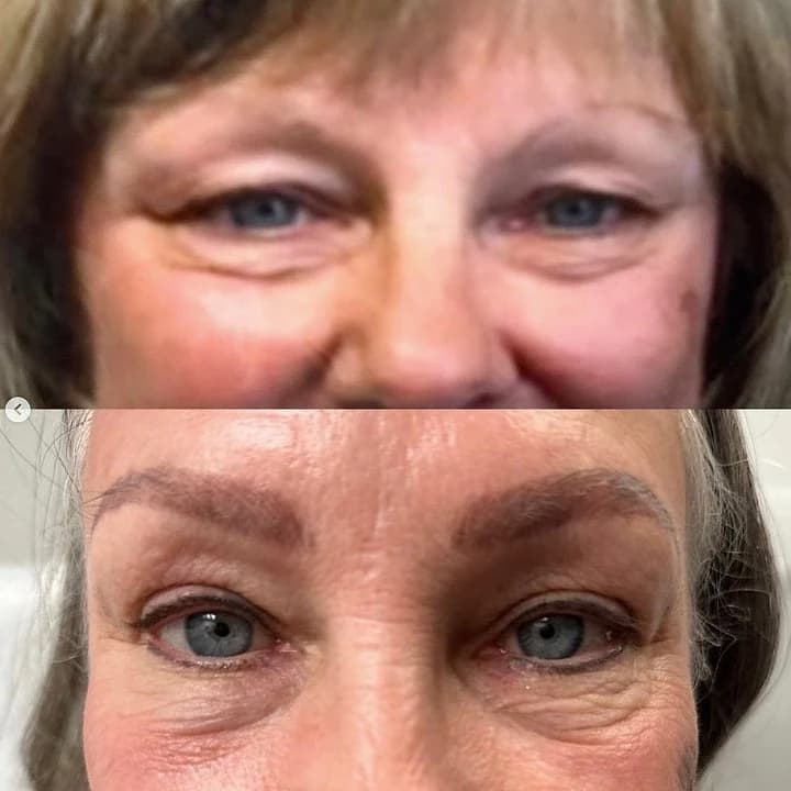 Upper and lower eyelids before and after cosmetic blepharoplasty