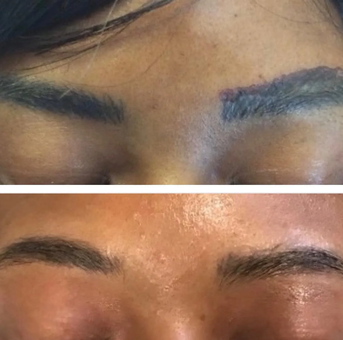Left eyebrow tattoo before Pico laser treatment and after several removal sessions