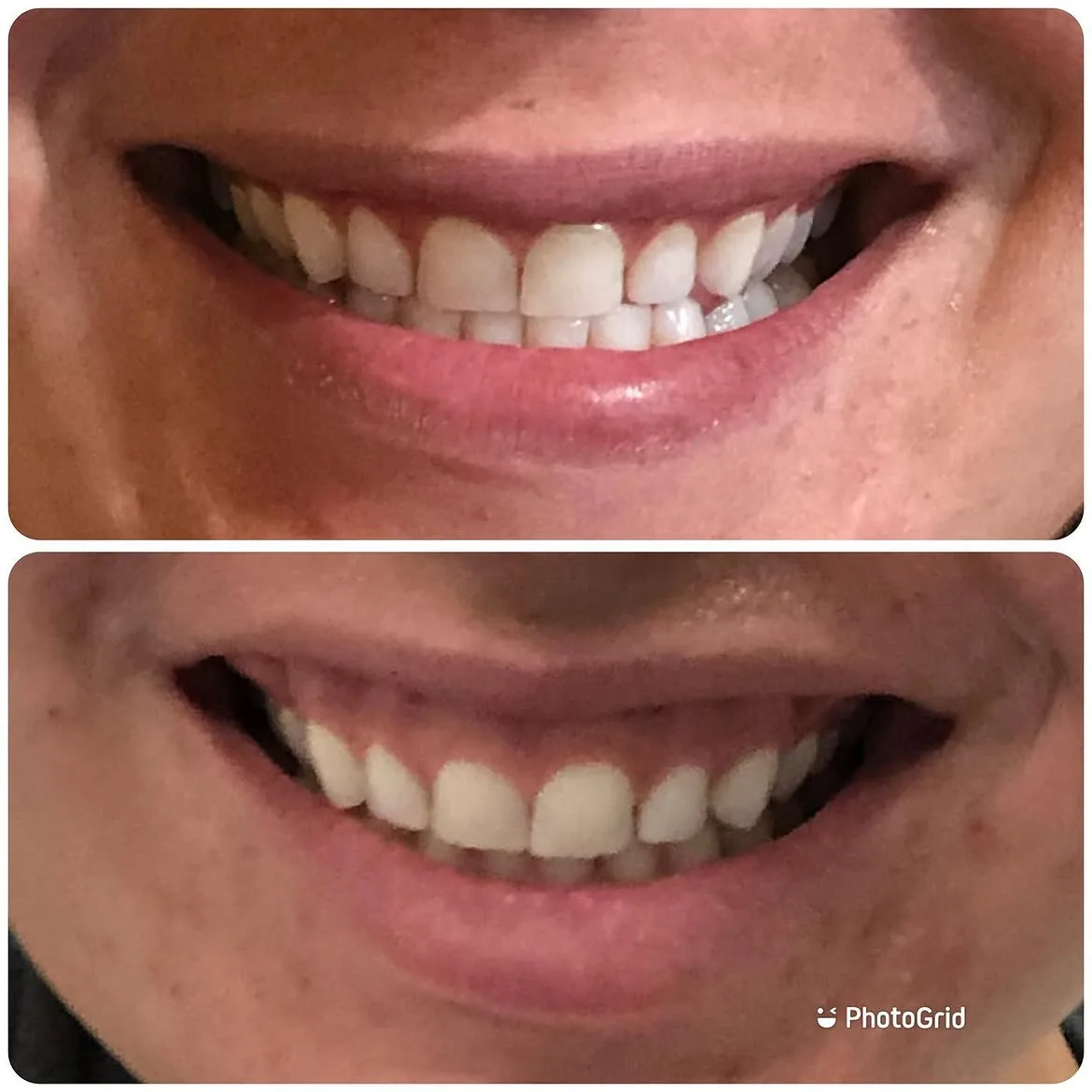 Gummy smile before Botox treatment and reduced gum show after one session