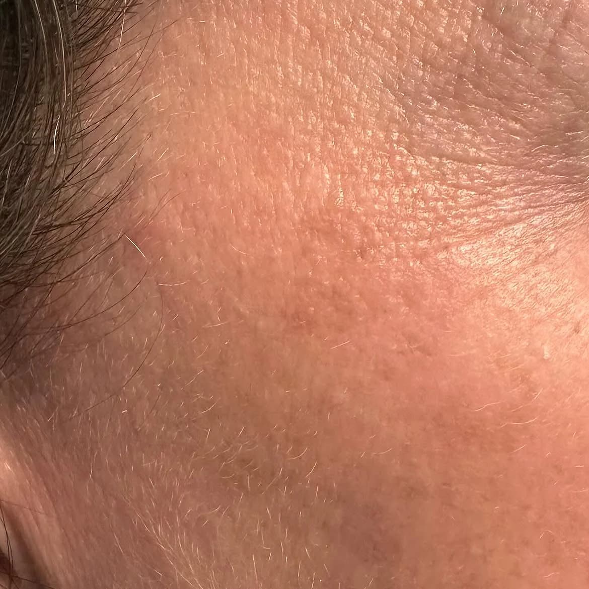 Skin after one Q-switched Nd:YAG laser treatment for a facial lentigo