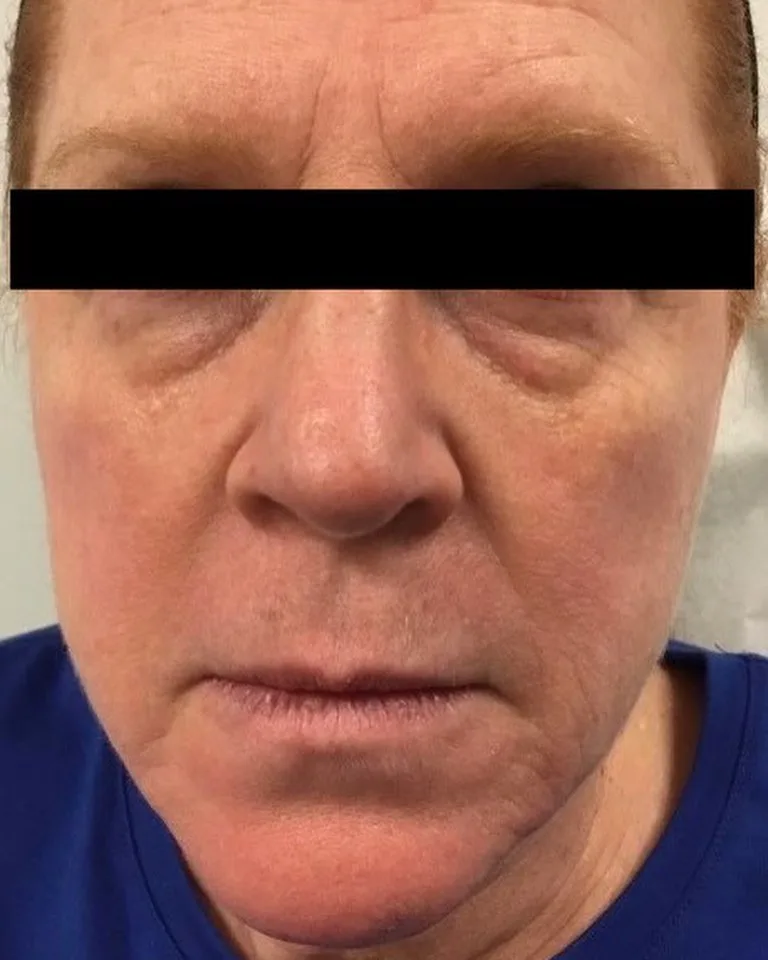 Under-eye hollowness and tear troughs before Restylane dermal filler treatment