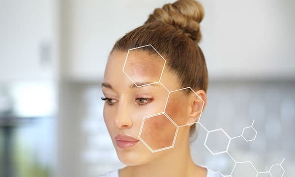Melasma