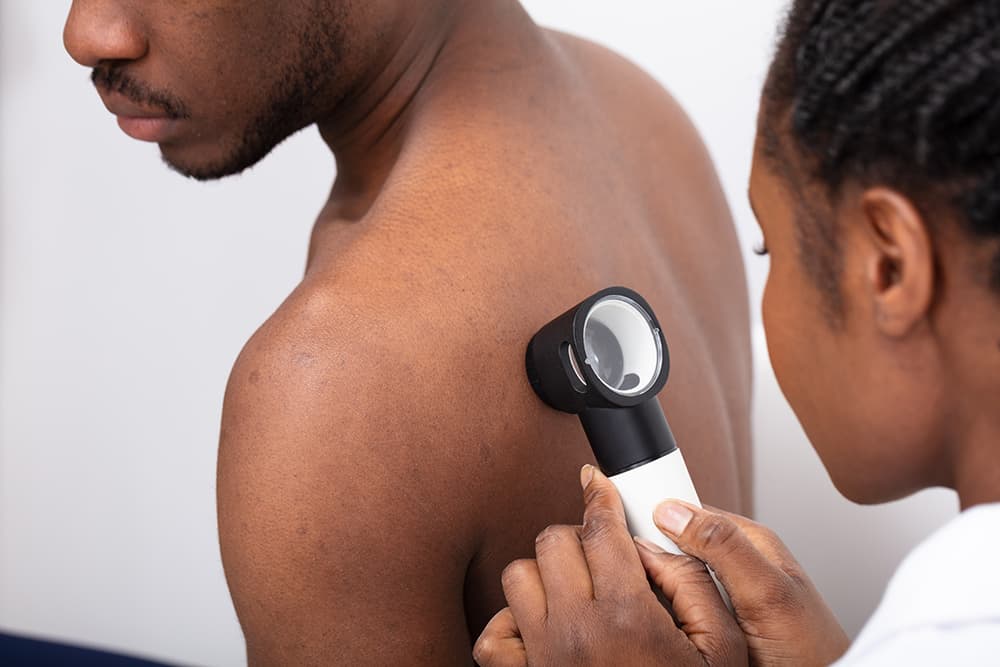 Sebaceous Hyperplasia Treatment