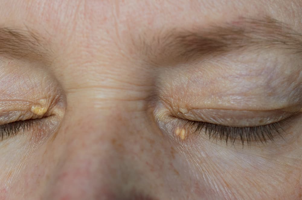 Xanthelasma Removal
