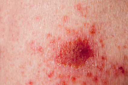 Basal Cell Carcinoma: What You Should Know
