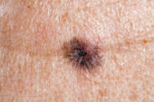 Moles and Melanoma: Knowing the Difference