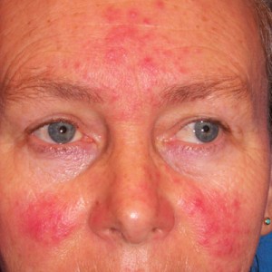 It's Rosacea Awareness Month