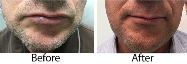 Laser Treatment for Venous Lake