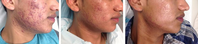 Acne scarring dermatology treatment at Skin & Laser Dermatology Center