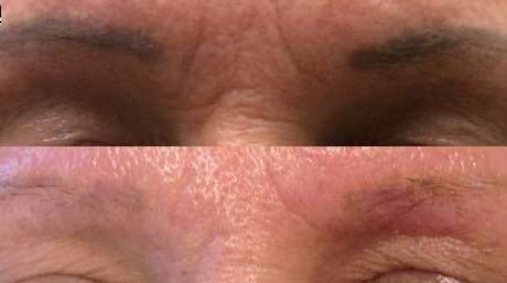 Permanent Make-Up Tattoo Removal